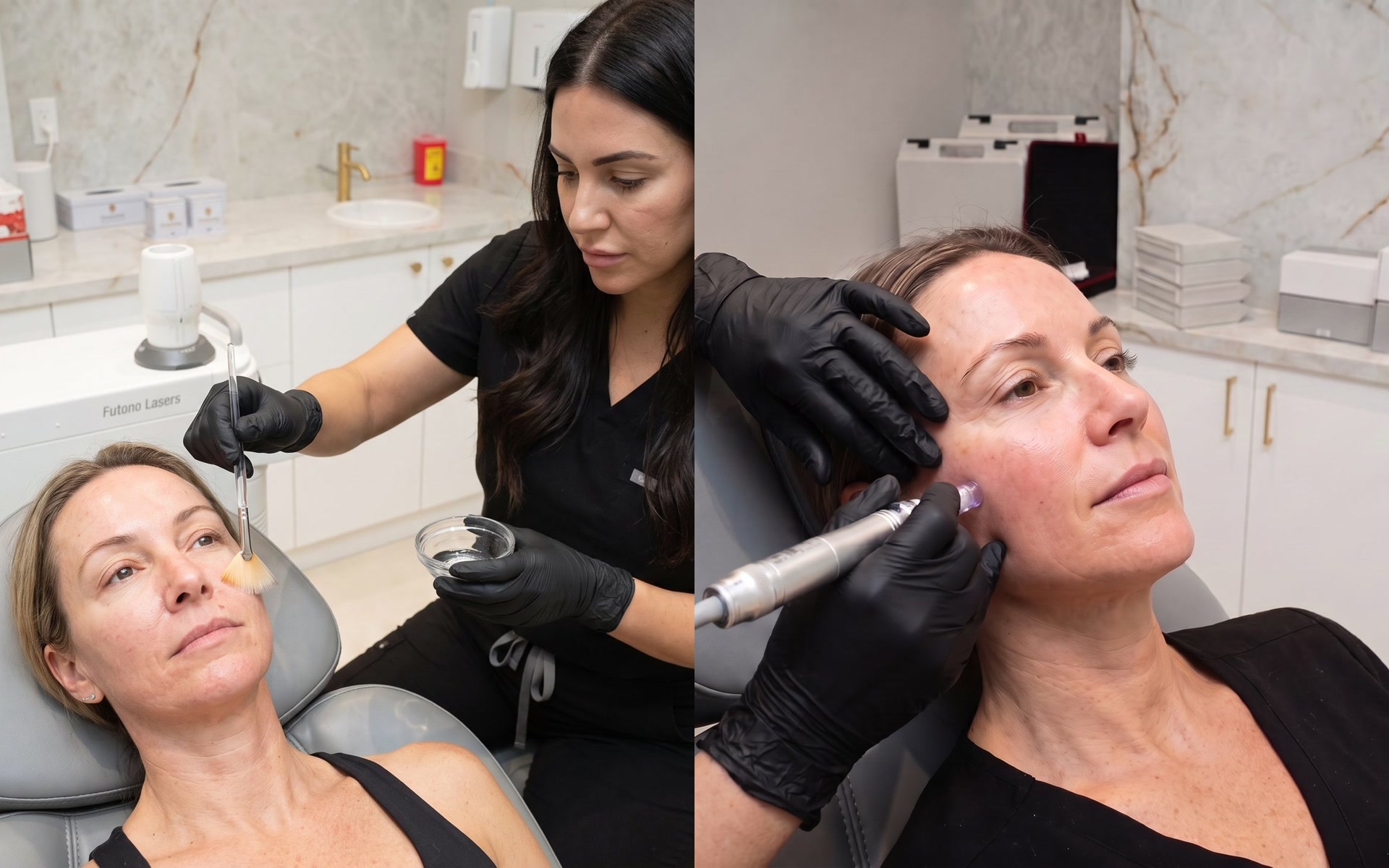 Chemical peel and microneedling treatments at Lumini Medical Spa in Aventura