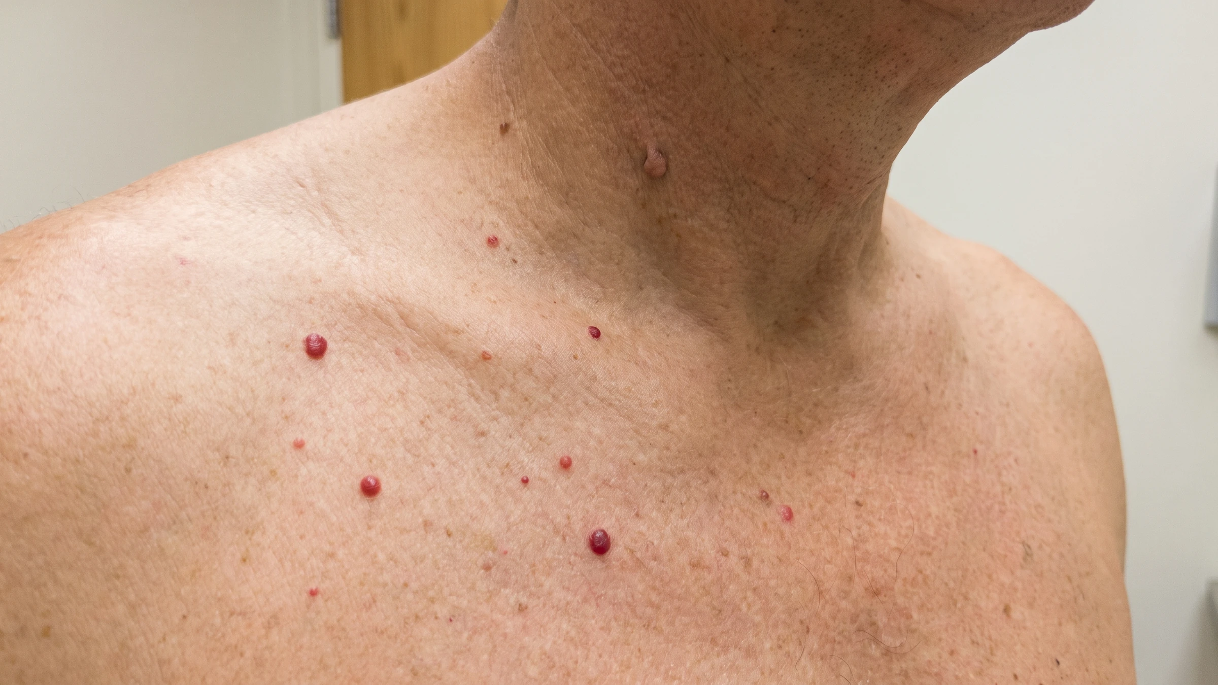 Cherry Angiomas and Skin Tags: What They Are and How Removal Works