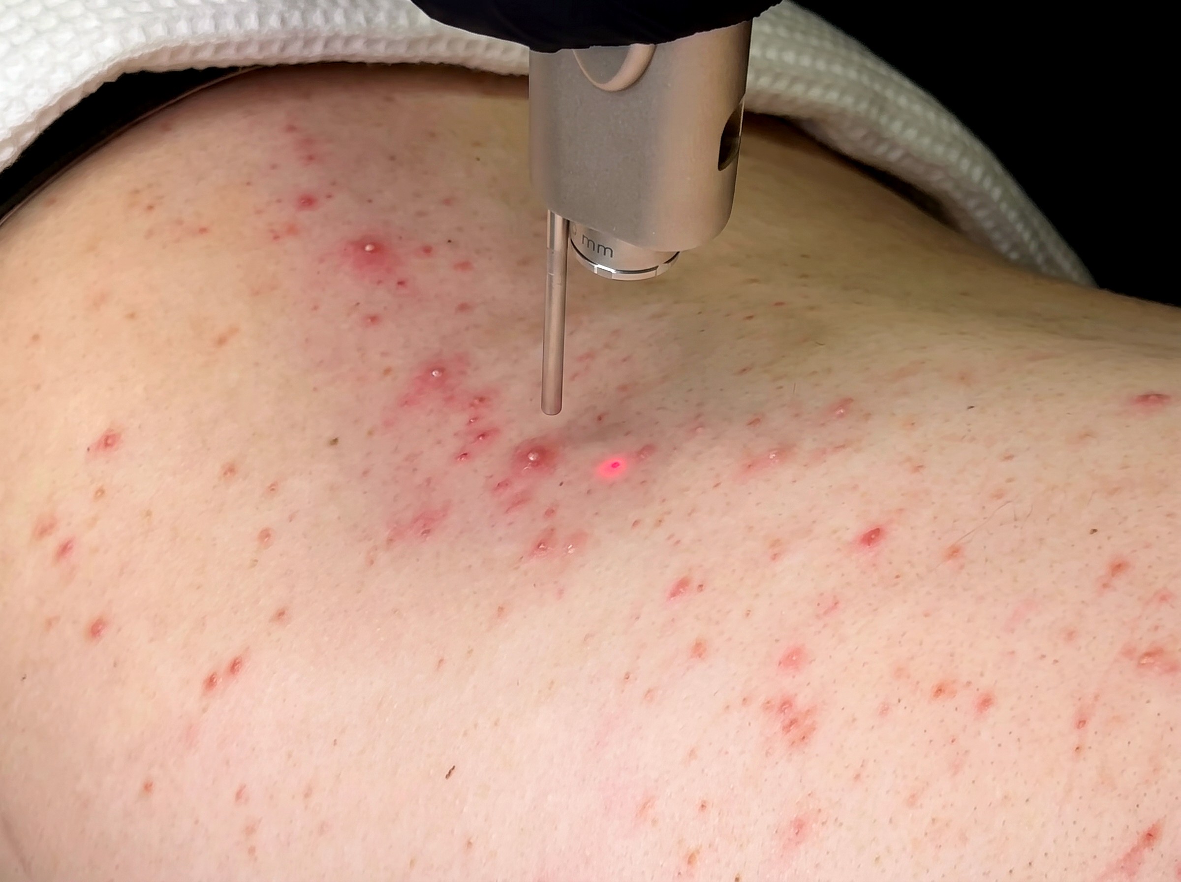Fotona Acne & Acne Scar Treatment at Lumini Medical Spa in Aventura, FL