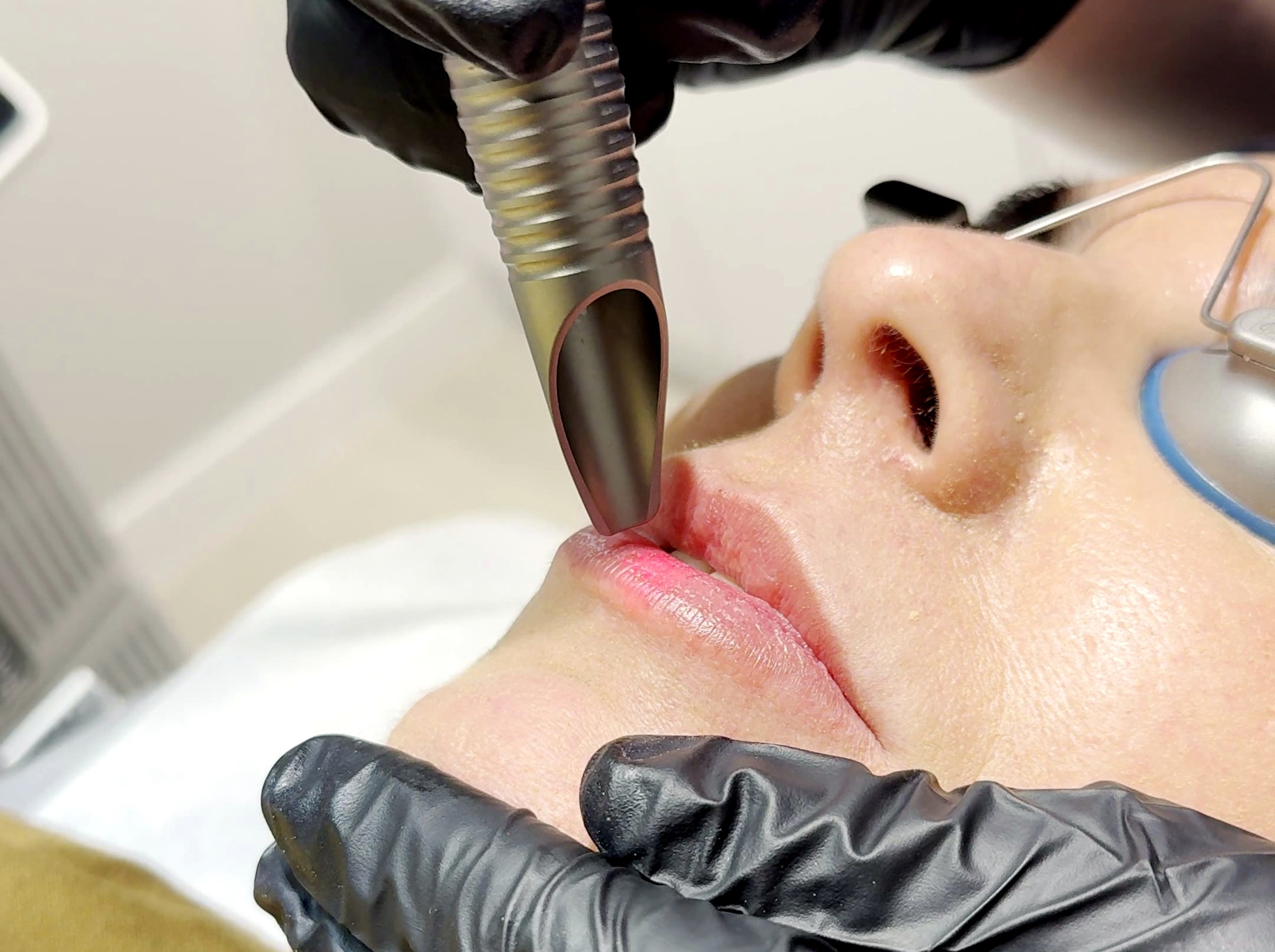 Fotona LipLase в Lumini Medical Spa в Aventura, FL