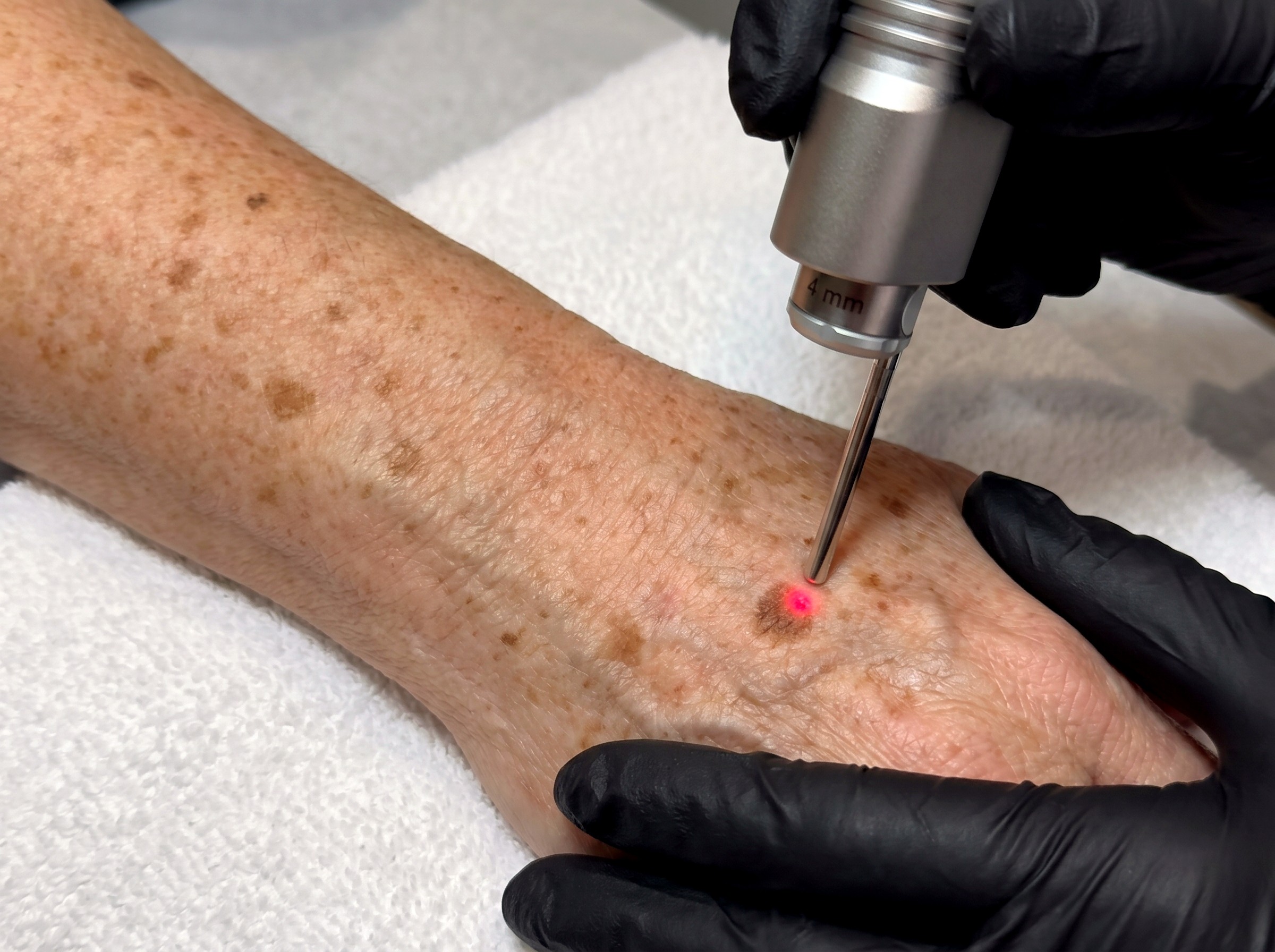 Fotona Pigment & Sun Spot Removal at Lumini Medical Spa in Aventura, FL