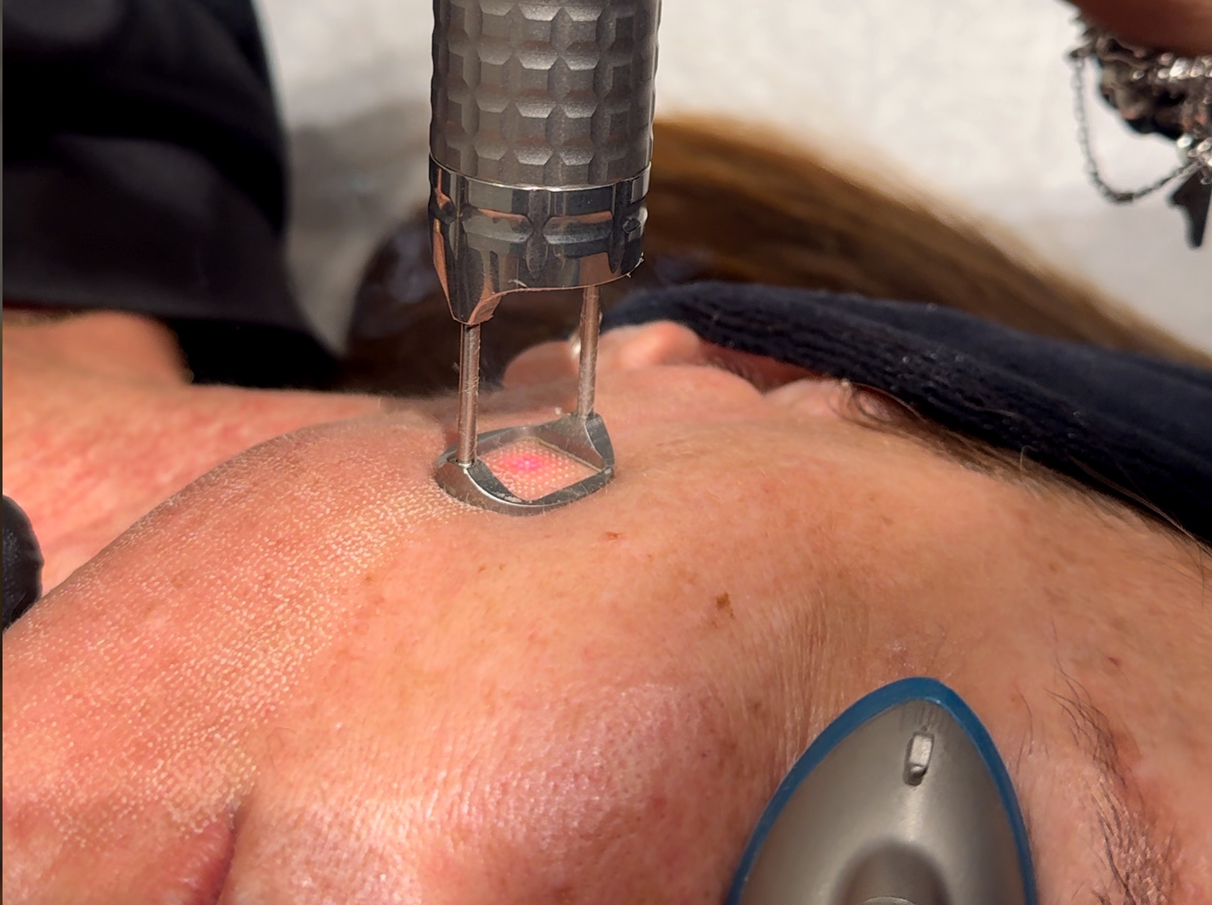 Fotona Skin Resurfacing at Lumini Medical Spa in Aventura, FL