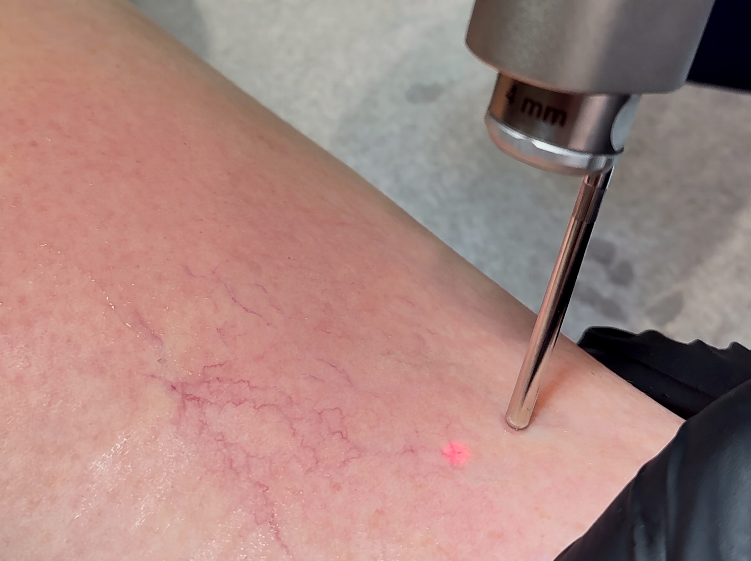 Fotona Vein & Redness Removal at Lumini Medical Spa in Aventura, FL