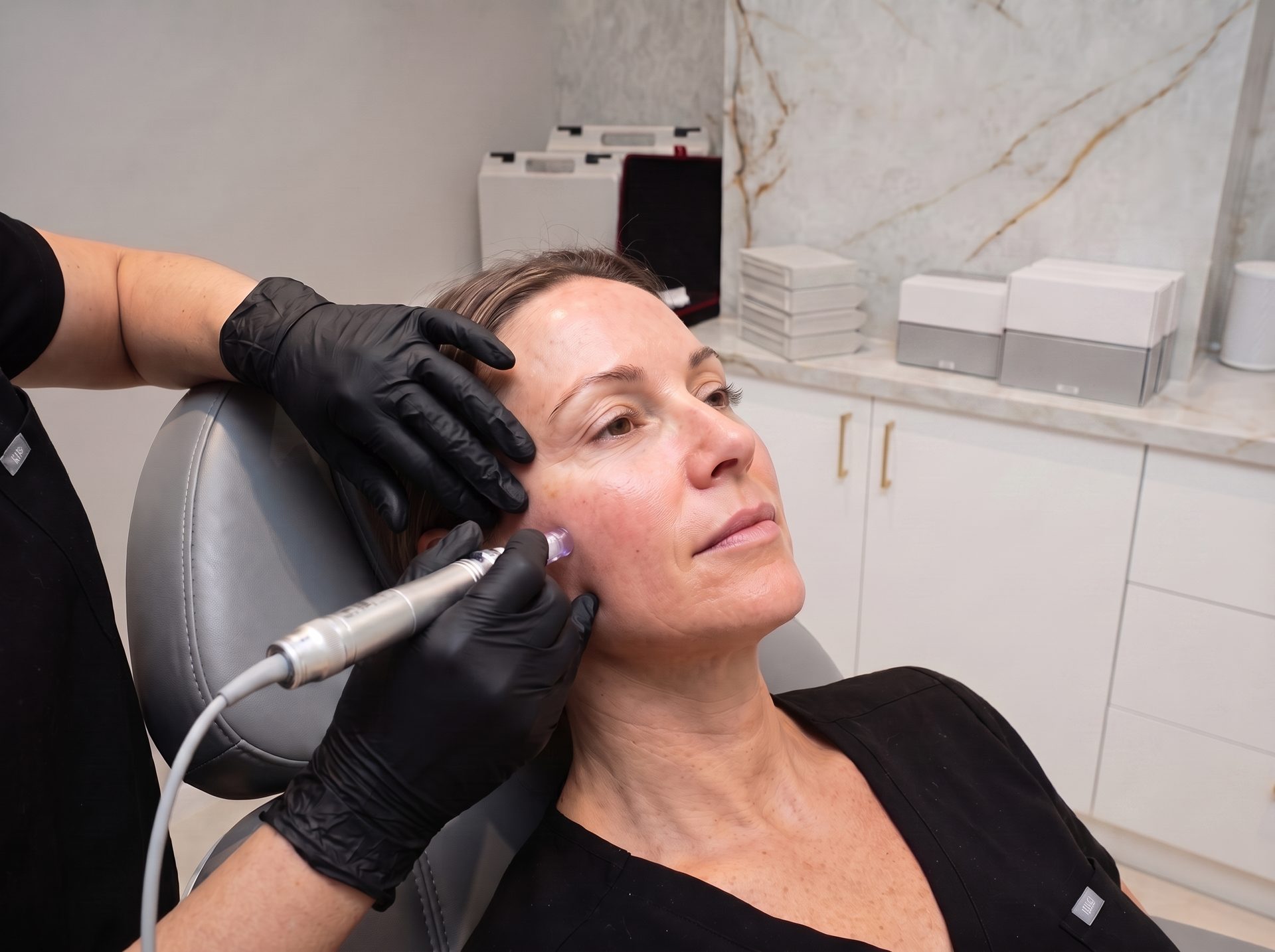 Microagulhamento na Lumini Medical Spa em Aventura, FL
